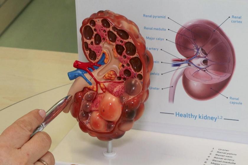 Böbrek hastalıkları sessiz ilerliyor, düzenli kontrol şart